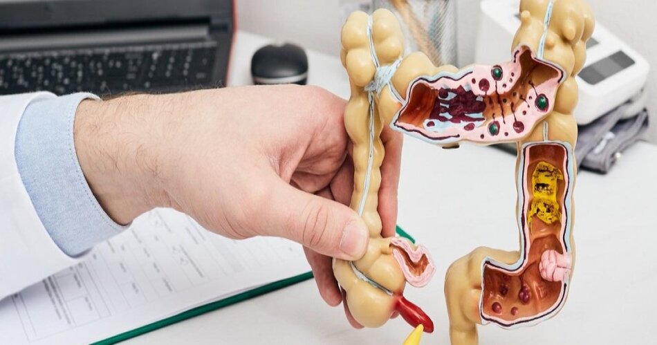 Na zdjęciu widoczny jest model anatomiczny ludzkiego jelita grubego, trzymany przez osobę w białym fartuchu, prawdopodobnie lekarza. Model szczegółowo przedstawia przekrój jelita, uwzględniając różne struktury wewnętrzne, co może być używane do celów edukacyjnych lub medycznych, takich jak wyjaśnianie procedur diagnostycznych, np. kolonoskopii.